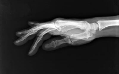 Basilar Thumb Arthritis – CMCJ OA