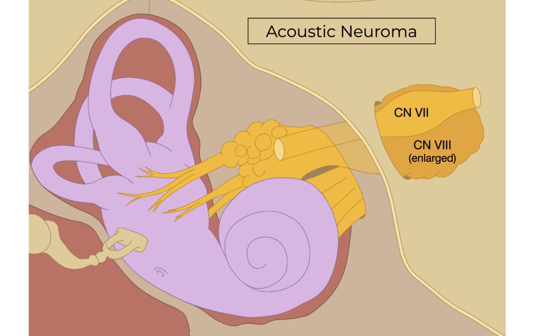 acoustic neuroma