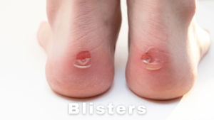 friction blister